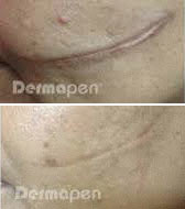 Dermapen before and after, first example