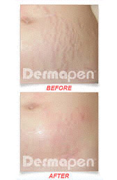 Dermapen before and after, second example